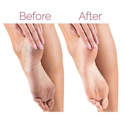 Electric Foot Callus Remover Rechargeable Pedicure File