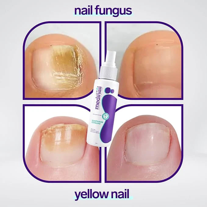 Jaysuin Nail Fungus Spray Fast Treatment for Healthy Nails
