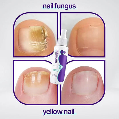 Jaysuin Nail Fungus Spray Fast Treatment for Healthy Nails